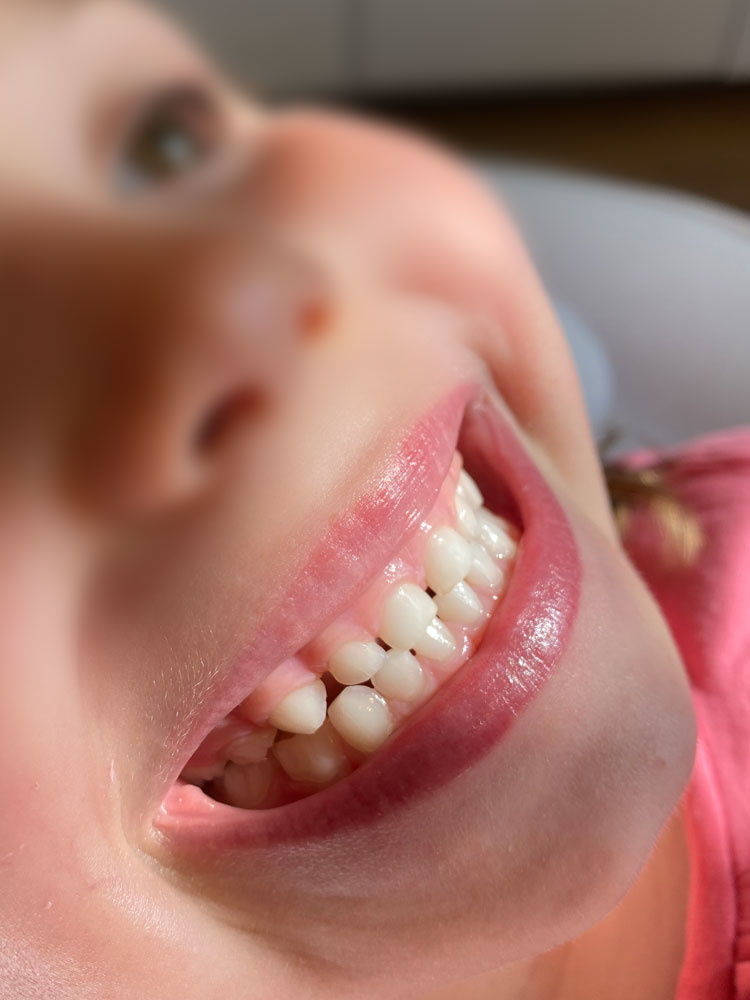 Zahnreinigung Kinder