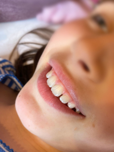 Zahnreinigung Kinder nachher