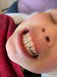 Zahnreinigung Kinder vorher